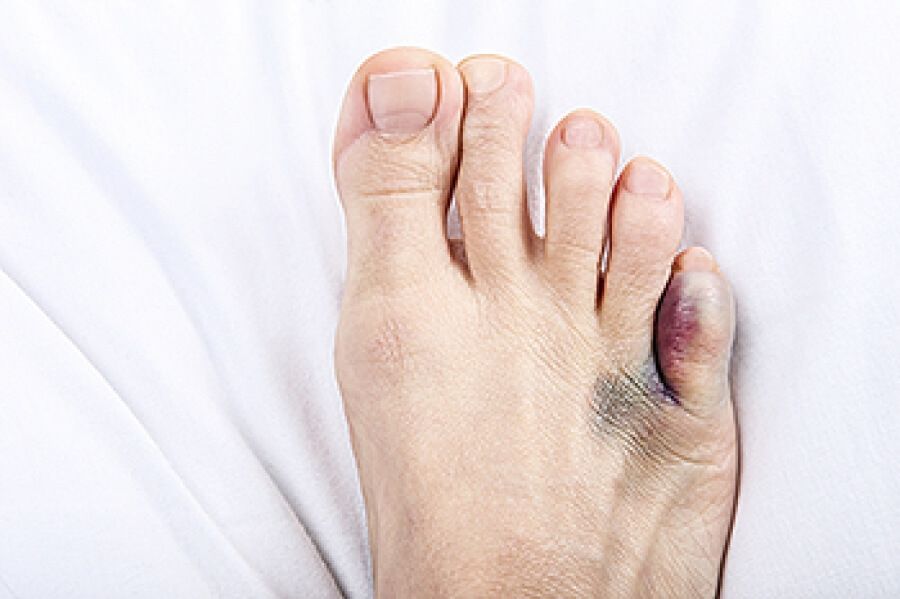 Making Sense Of Pinky Toe Pain